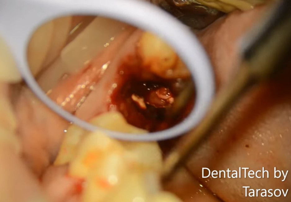 Dental Tech стараются сохранить третьи моляры