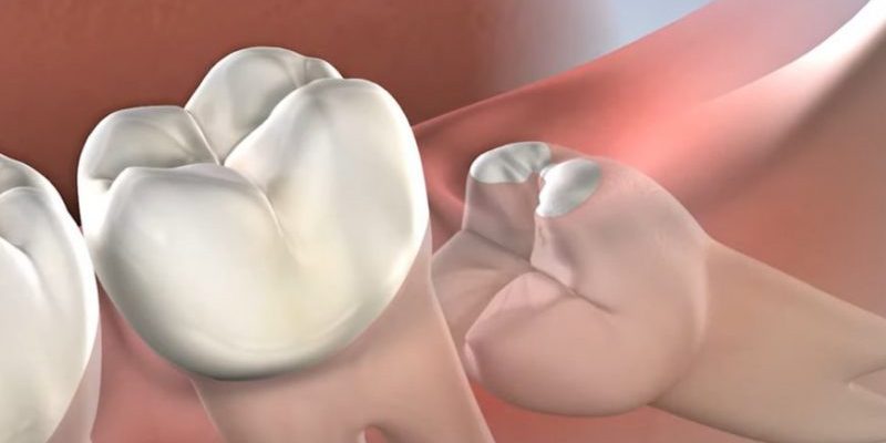 Удаление зубов мудрости в dental tech