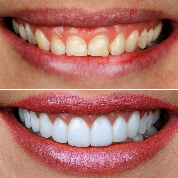 emax veneers e max