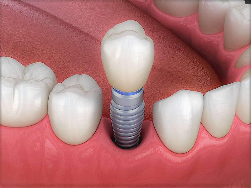 implantacziya