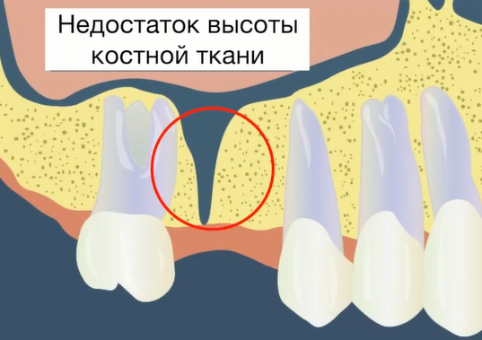 nedostatok vыsotы kostnoj tkany