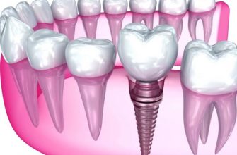 odnoetapna implantacziya zubiv