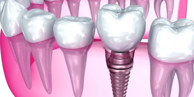 odnoetapna implantacziya zubiv