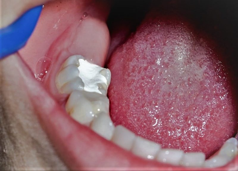 plombuvannya zubiv