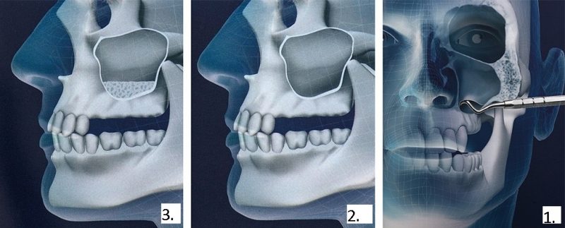 sinus lift